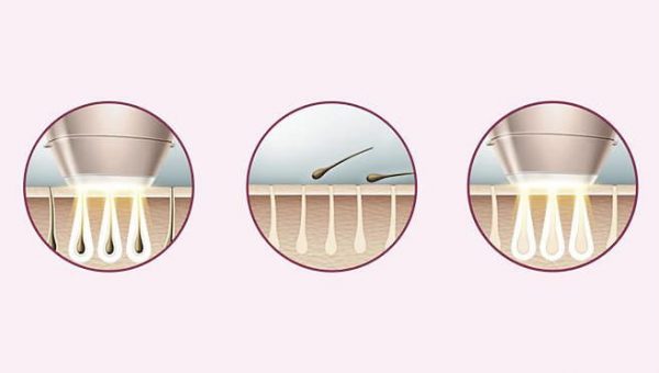 Epilarea IPL cum functioneaza